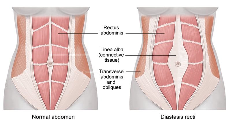 how do you know if you have abdominal separation Diastasis Recti