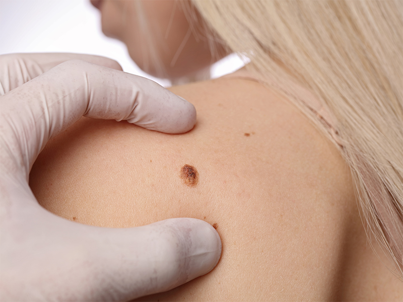 Dermatology practice singapore mole removal
