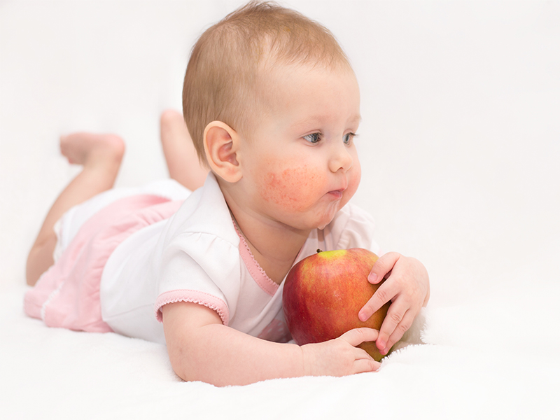Dermatologist baby actopic eczema