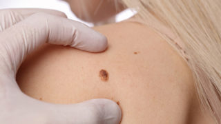 skin cancer checks dermatologist