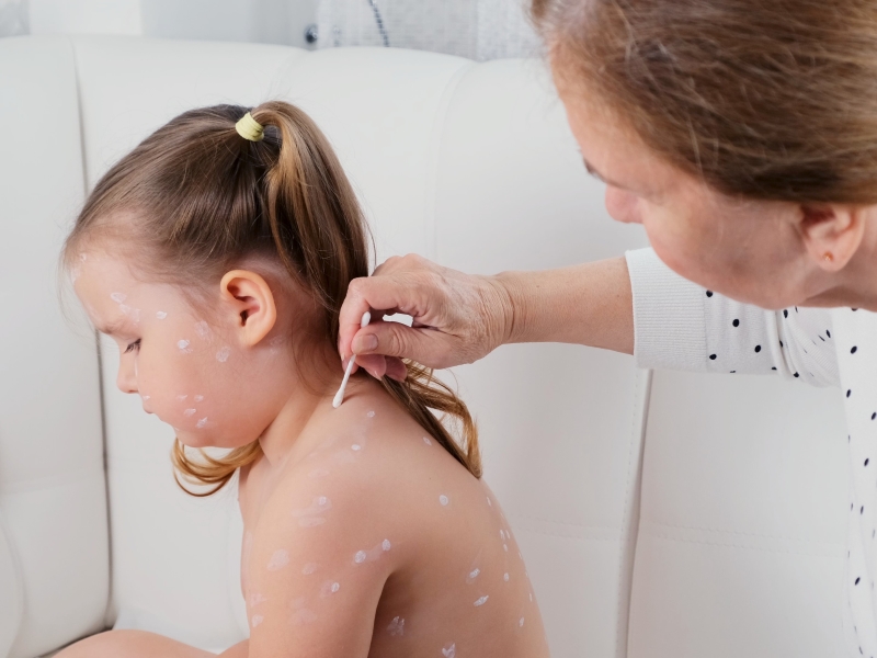 image of child with chicken pox for medical insurance for children story