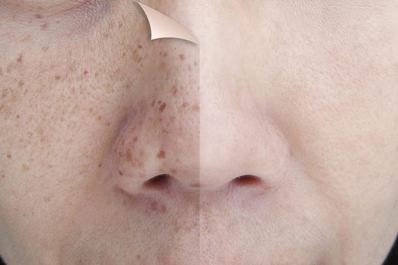 amaris b clinic laser facial treatment acne scars pigmentation