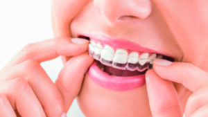 Invisalign clear aligners