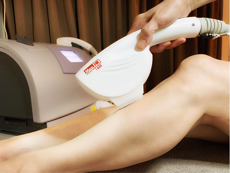 laser hair removal treatment singapore