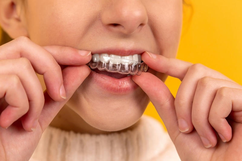 Invisalign and braces in Singapore - how to get straight teeth - teeth straightening treatment by dentists in Singapore, dental clinics Invisalign and braces in Singapore - how to get straight teeth - teeth straightening treatment by dentists in Singapore, dental clinics