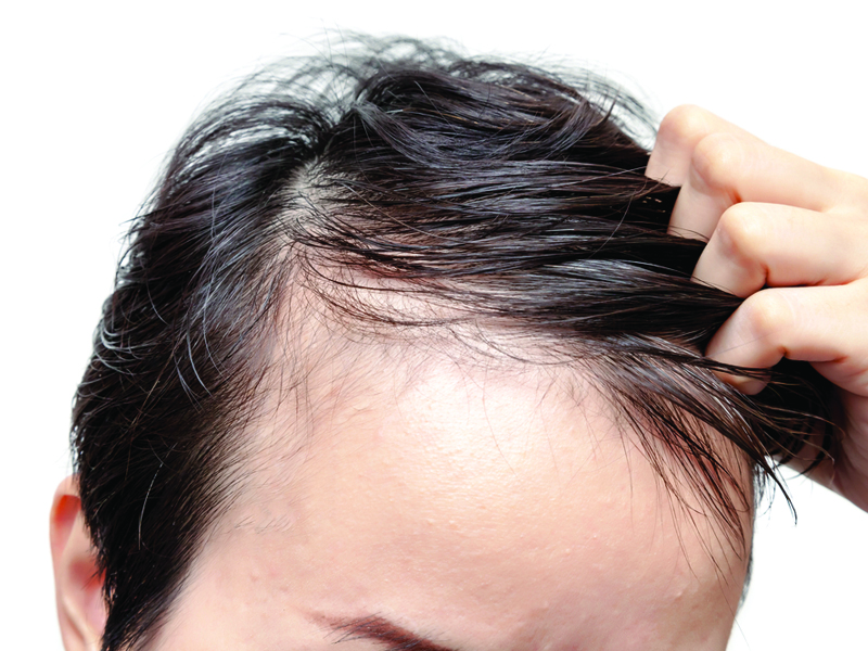 male hair loss balding phs hairscience singapore