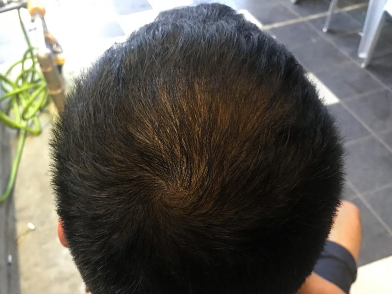 phs hairscience miracle stem cell treatment for balding phs hairscience miracle stem cell treatment for balding