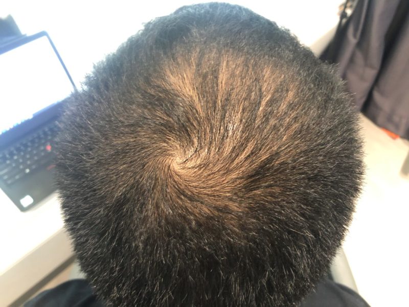 phs hairscience miracle stem cell treatment for balding