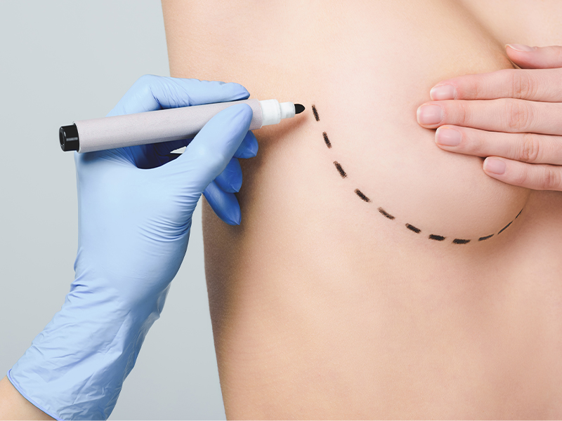 Breast augmentation surgery