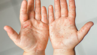 hand foot and mouth disease HFMD symptoms