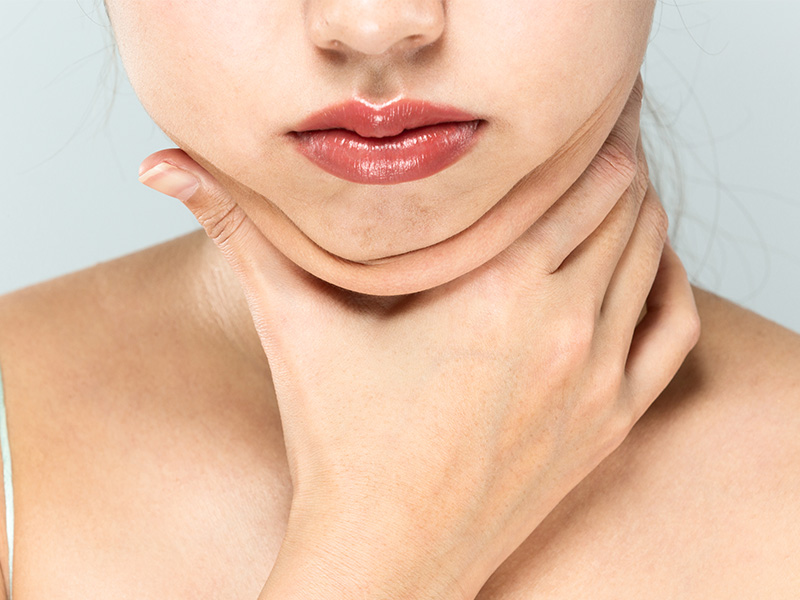 neck fat facial liposuction