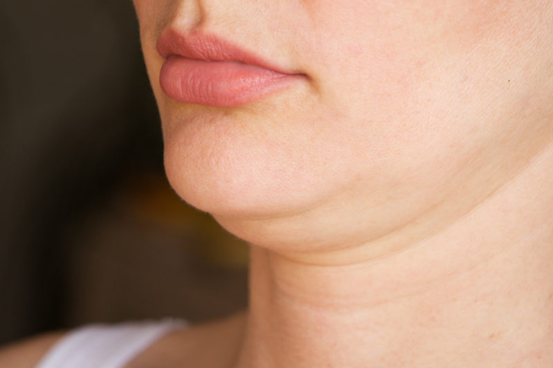 facial liposuction for double chin and fat neck 
