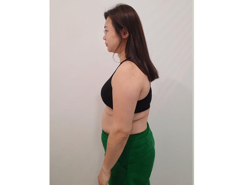 Left side view before weight loss