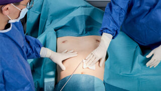 singapore liposuction azataca