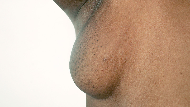 axillary breast in armpit