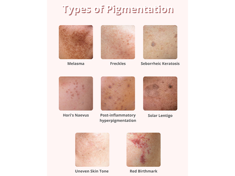 types of pigmentation removal 
