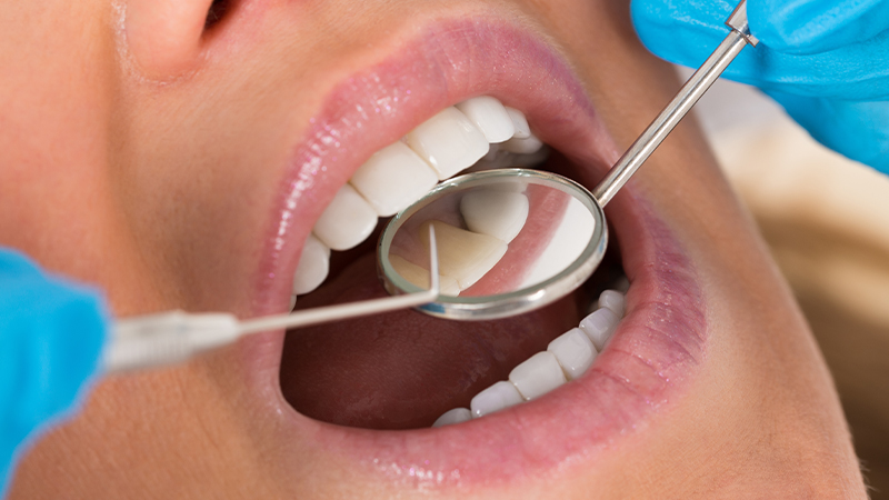 Aesthete Smilestudio is among the dental clinics in Singapore to use amalgam-free dental fillings 