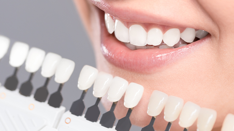 teeth whitening singapore dentists