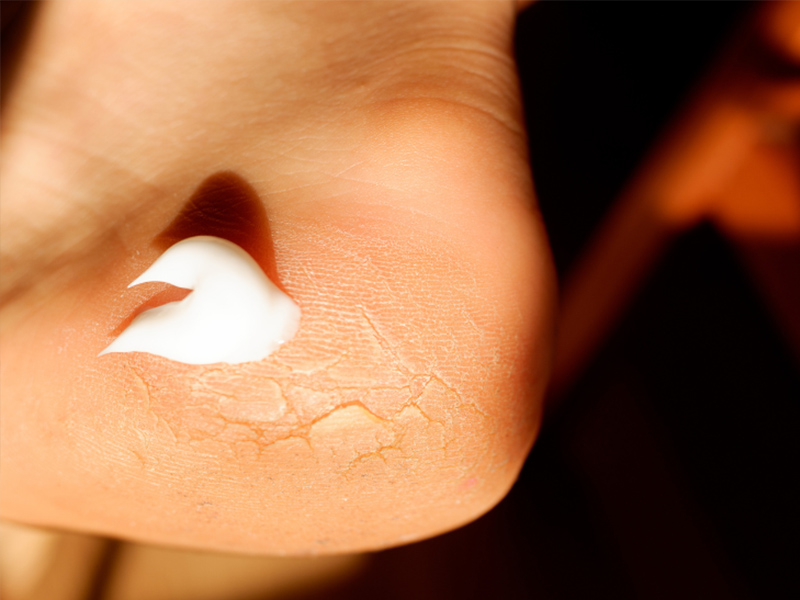 cracked heel cream moisturiser for dry skin