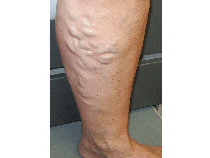 varicose veins treatment