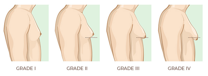 gynecomastia surgery singapore man boobs