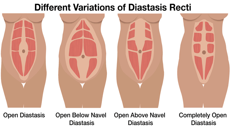 Rectus Diastasis treatment singapore Dr Marco pelvic floor dysfunction