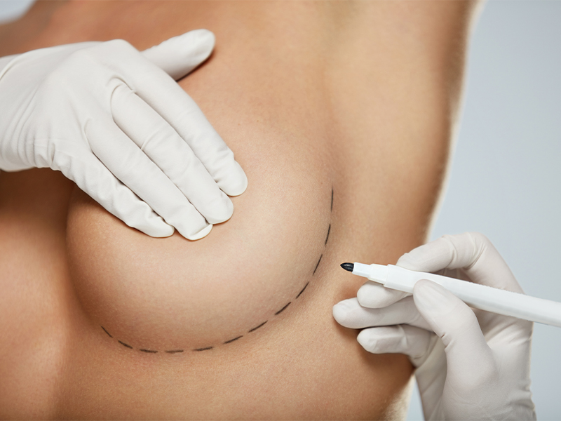 breast size breast augmentation in Singapore