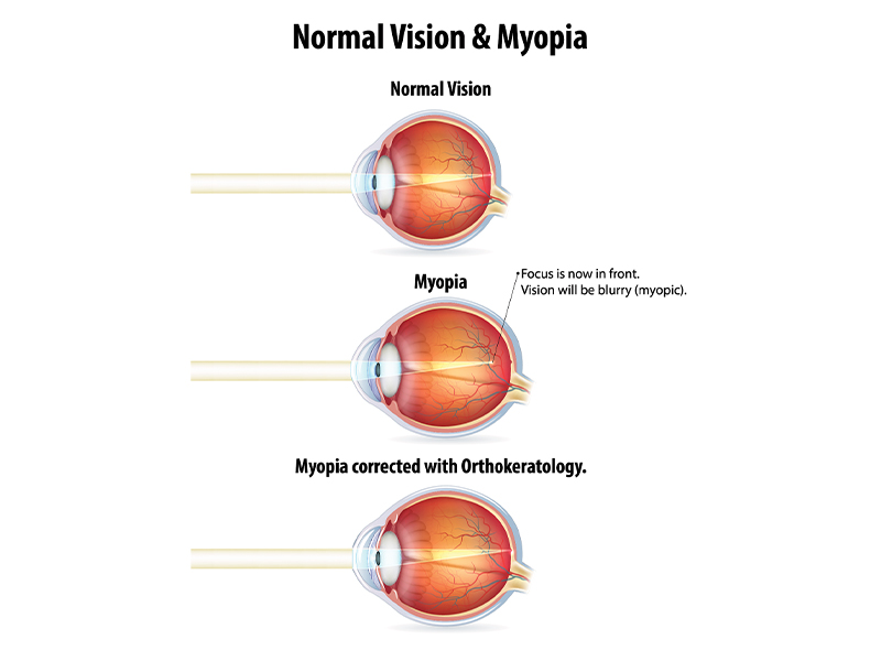 myopia treatment