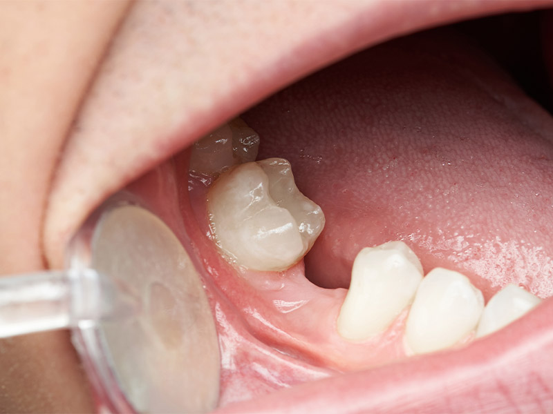 dental implants in singapore options for tooth replacement 