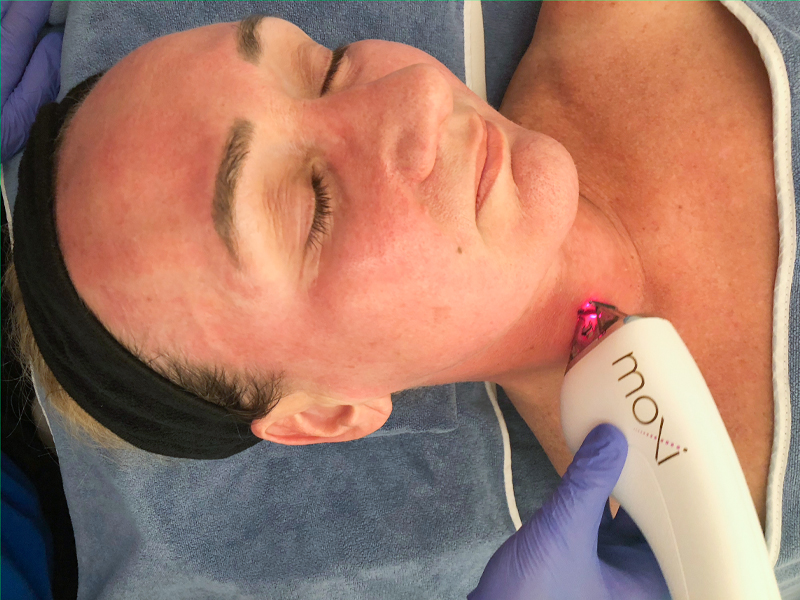 Moxi laser pigmentation treatment Bay Aesthetics Clinic, BBL