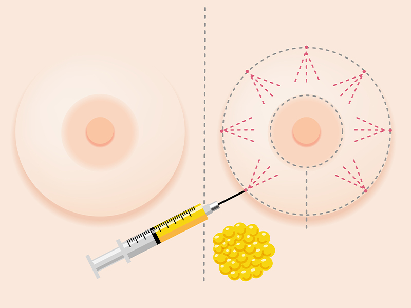 breast fat grafting breast surgery 