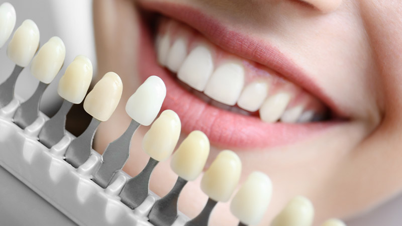 singapore dentist for teeth whitening at dental clinic
