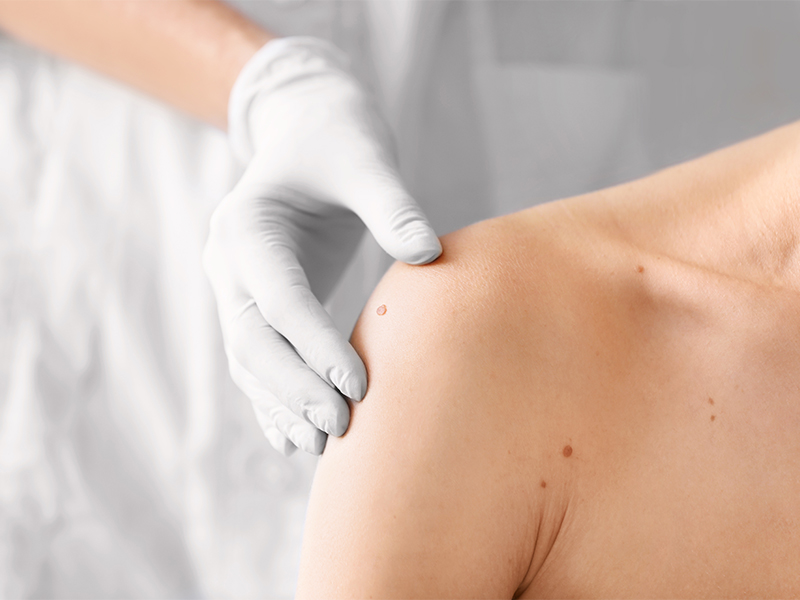 dermatology skin cancer checks dermatologist