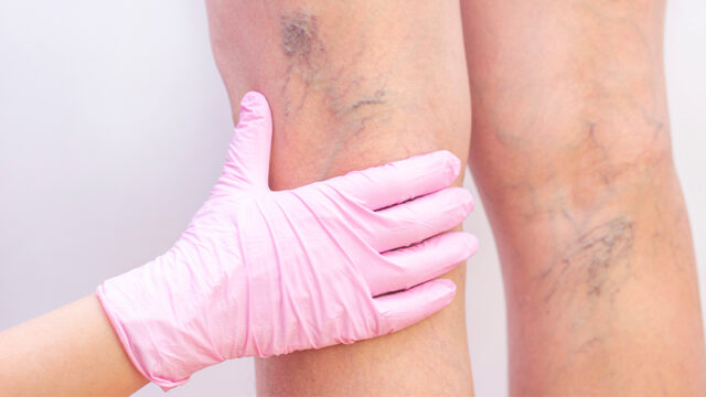 varicose veins treatment and operation