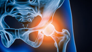 Hip osteoarthritis labral tears and hip pain causes