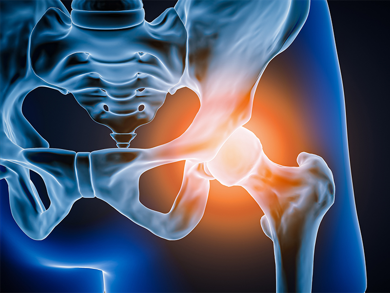 Hip osteoarthritis labral tears and hip pain causes