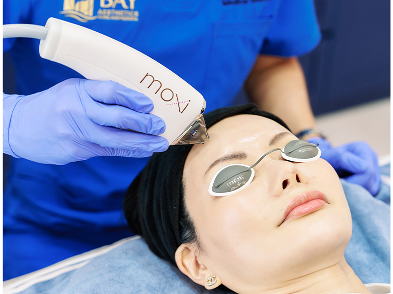 Laser treatments in Singapore for the face, acne scars and more - Moxi