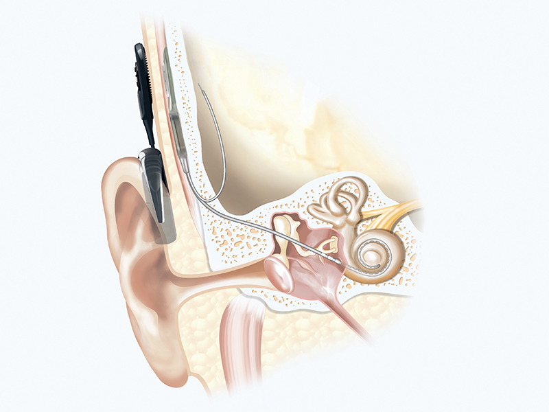 cochlear implants for hearing loss