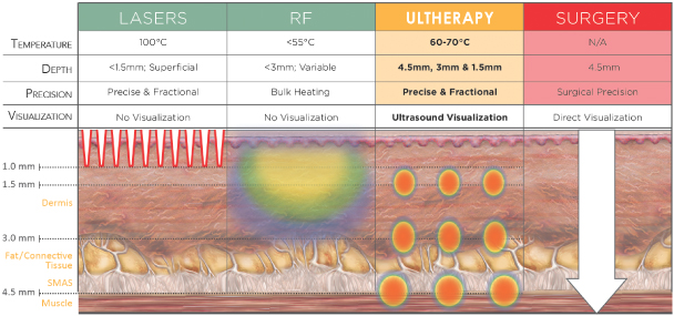 Ultherapy in Singapore for face lift for droopy eyes at Bay Aesthetics Clinic 