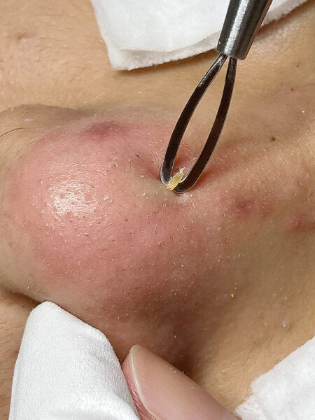 Extraction facials in Singapore for blackheads and clogged pores 