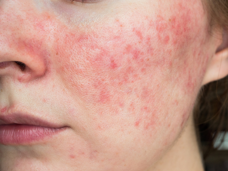 What is rosacea - more about this common inflammatory skin condition and rosacea treatment options that could help.