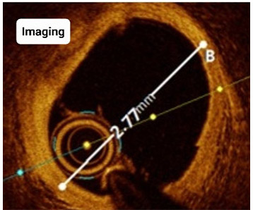 Coronary artery disease - doctor from The Harley Street Heart & Vascular Centre discusses artery blockage treatment including angioplasty