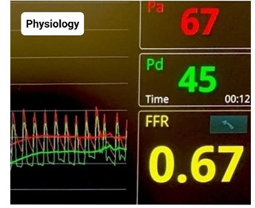 Coronary artery disease - doctor from The Harley Street Heart & Vascular Centre discusses artery blockage treatment including angioplasty