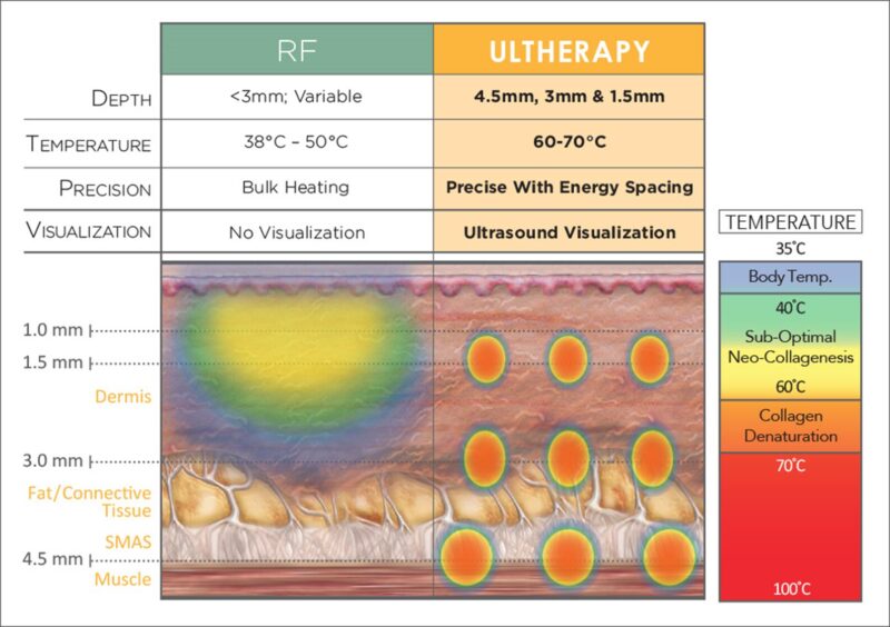 radiofrequency VS ultherapy