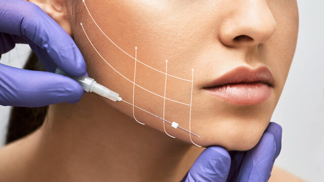 Thread lift in Singapore - how it compares to a face lift, according to Dr Lee Hanjing of Argent Plastic Surgery