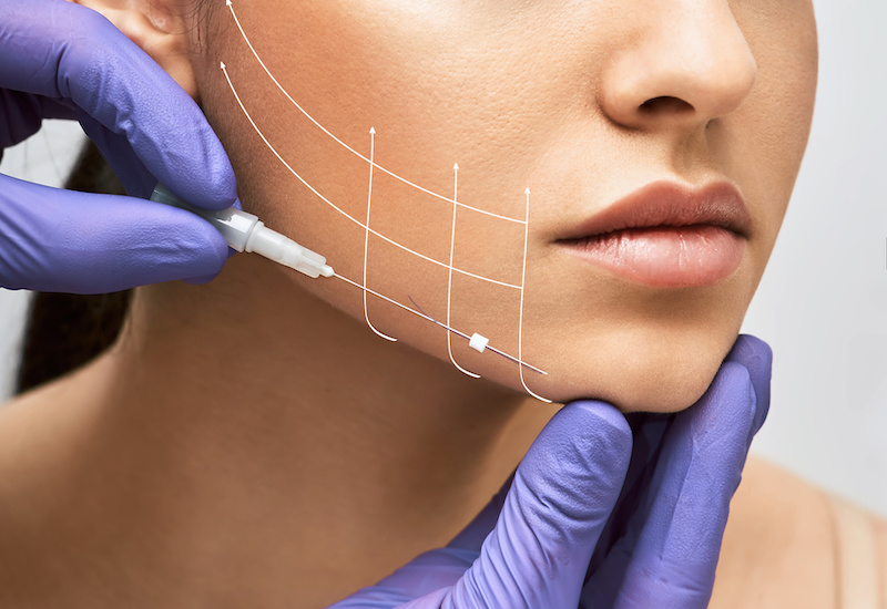 Thread lift in Singapore - how it compares to a face lift, according to Dr Lee Hanjing of Argent Plastic Surgery