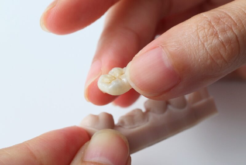 Dental crown in Singapore - what's dental crown - Dental Designs Clinic