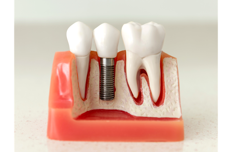 Dental Designs Clinic - how dental implants offer more than just the replacement of missing teeth