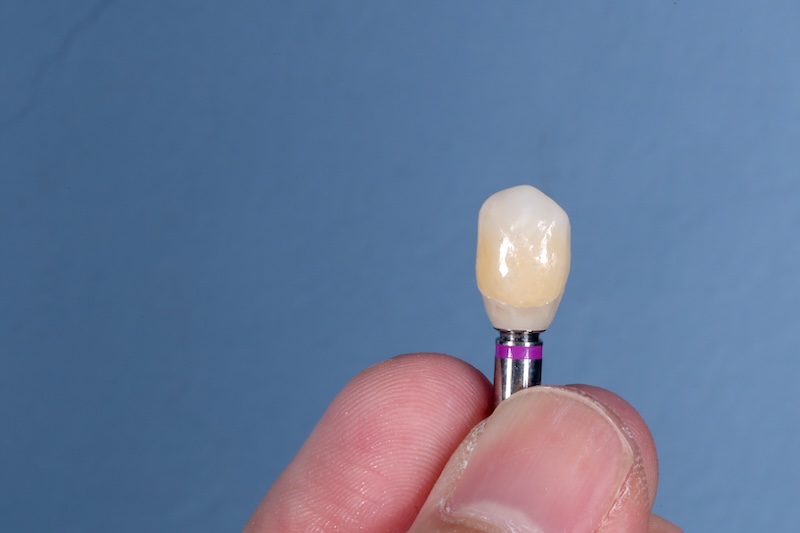 Dental Designs Clinic - how dental implants offer more than just the replacement of missing teeth