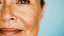 Dermatology Collective Clinic & Surgery - pico laser treatment in Singapore for sun spots, acne or pimple scars and other tropical skin concerns